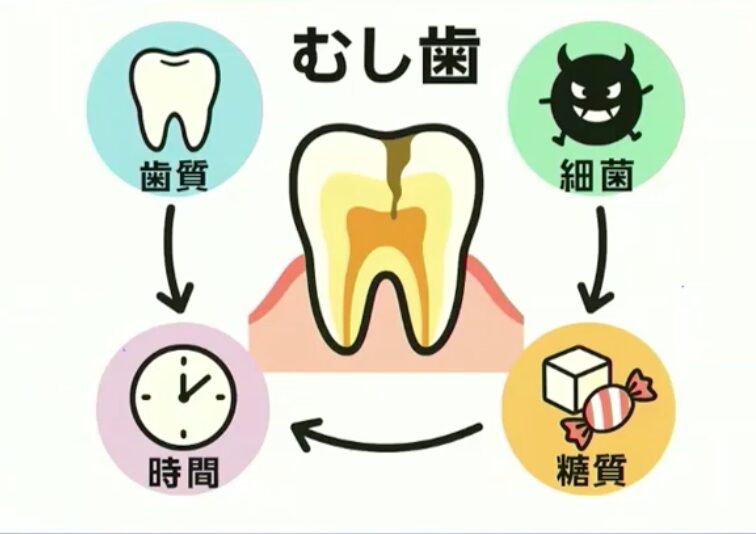 虫歯の成り立ち